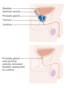 Diagram showing before and after a radical prostatectomy Diagram showing before and after a radical prostatectomy CRUK 473.svg