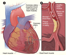 Coronary Arteries Wikipedia