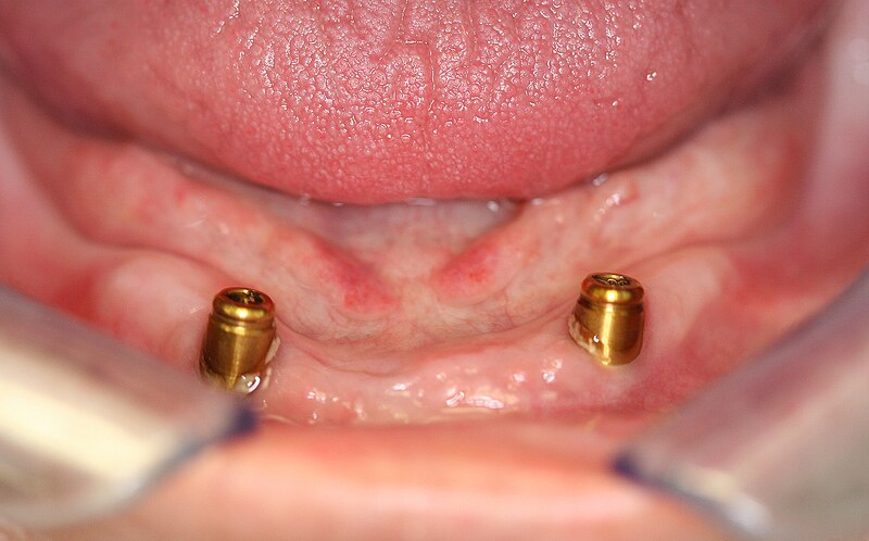 File:Implant overdenture button style retainers.jpg