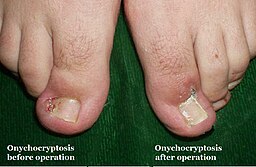 Ingrown Toenail, Onychocryptosis, Wedge Resection 01