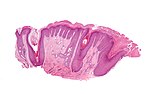 Thumbnail for Lichen simplex chronicus