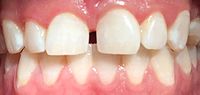 Thumbnail for Dental attrition