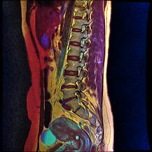 Color MRI showing nabothian cyst as small blue circle in cervical region. Lumbar MRI T1FSE T2frFSE STIR 11.jpg