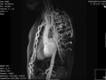 МРА грудне аорте и њених колатерала