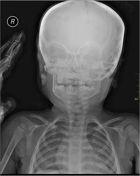 File:Medical X-Ray imaging VGE07 nevit.jpg