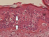 Micrograph of perinuclear vacuolization, annotated.jpg