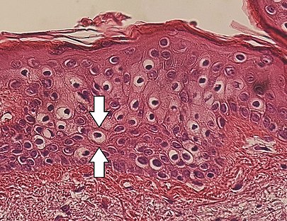 Perinuclear vacuolization of epidermal keratinocytes (one indicated by arrows), in this case an insignificant incidental finding. Micrograph of perinuclear vacuolization, annotated.jpg