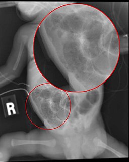 Necrotizing enterocolitis Human disease