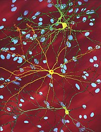 'n mikroskoopbeeld van medium stekelrige neurone (geel) met kern insluitings (oranje), wat ontstaan ​​as deel van die siekteproses, beeld breedte 360 μm