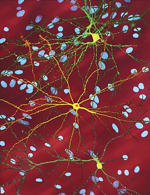 На мікрознімку (360 µм) показано декілька нейронів (жовтий колір), що демонструють велике центральне ядро від якого розгалужуються декілька дюжин джгутиків; спереду ядро нейрона з нуклеарними включеннями (помаранчевого кольору), що займає приблизно чверть діаметра ядра