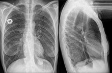 Chest radiograph showing a stent in the distal esophagus Oesophagustent bei Karzinom - Roe pa und seitlich 001.jpg