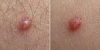 a papilloma vírus megszünteti