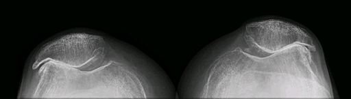 Patellofemoral Osteoarthritis Severe