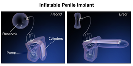 Penile Implant.png