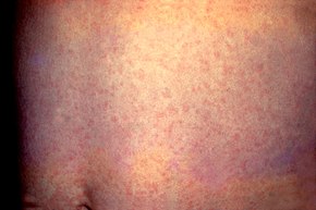 Generalized rash on the abdomen due to rubella Rubella.jpg