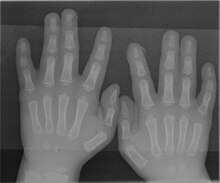 Radiograph of Type 1 Syndactyly Syndactyly type1 hands.jpg