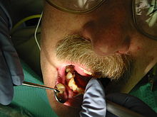 A dental hygienist demonstrates scaling Tooth scaling 9301.JPG