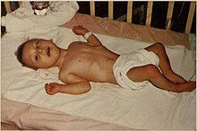Child with congenital toxoplasmosis Toxoplasmosis, Congenital.jpg