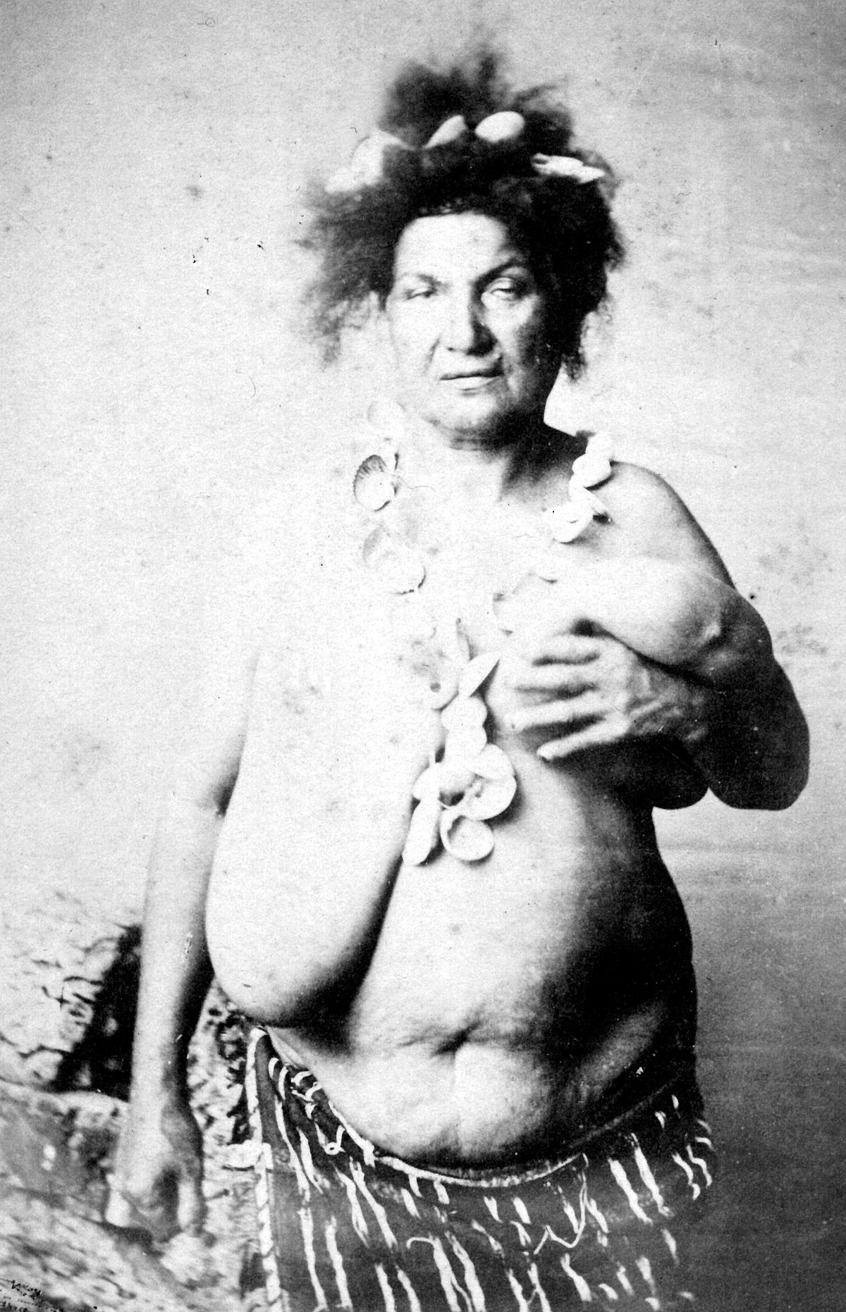 File*+ * Photographic documentation on sexual education - Hypertrophy of breast - Nude of an elderly woman around 1870 - Photographer unknown - Public domain, since the copyright has expired;