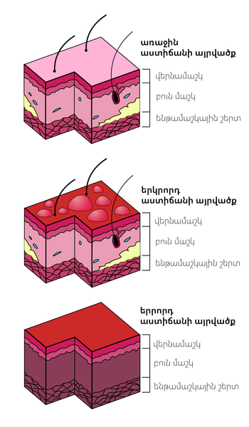 File:Burn Degree Diagram (hy).png