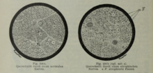 Histological comparison of a normal nerve and an atrophied nerve using a cross-slice of the sciatic nerve. Left is a normal nerve. Right is an atrophied nerve. Cross section normal nerve and atrophied nerve.png