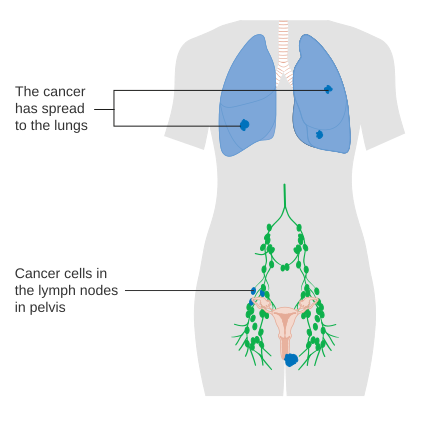 File:Diagram showing stage 4B cancer of the vulva CRUK 238.svg
