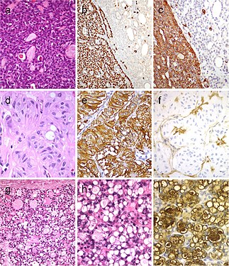 Histopathology of thyroid tumor with solid cell nest features, and hyalinizing trabecular tumor.jpg