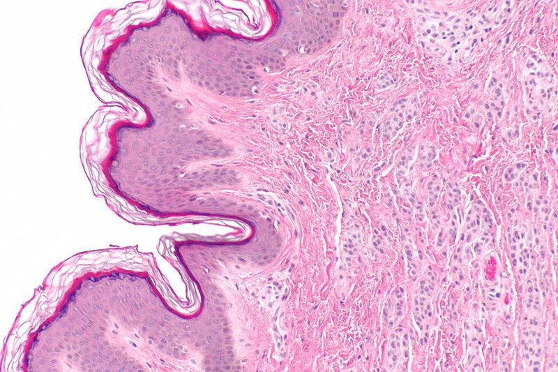 File:Intradermal nevus -- intermed mag.jpg