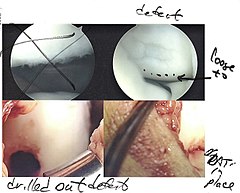 OATS-Arthroscopic Scan1