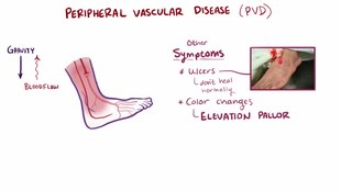 ملف:Peripheral vascular disease video.webm
