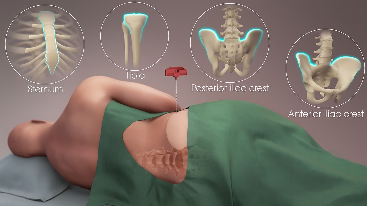 Arthrex - Posterior Iliac Crest Bone Marrow Aspiration - Prone