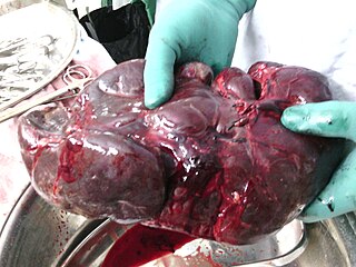 Splenectomy Surgical removal of the spleen