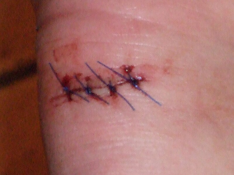 File:Sutures6.JPG