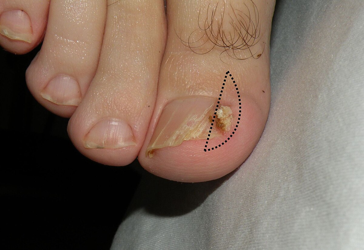 Ingrown Toenail Treatment, Causes & Prevention - Foot Pain Explored