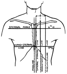 Vertical lines: Midline, lateral sternal line, parasternal line and midclavicular line. Horizontal lines: Level of the sternal angle, and zipho-sternal line. Brantigan 1963 1-51.png