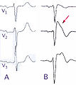 Brugada EKG Schema.jpg