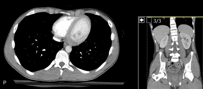 CT of a normal abdomen and pelvis, axial plane 2.png