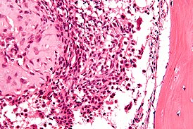 Micrografía de condroblastoma.  Teñido con hematoxilina y eosina