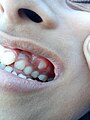 Dental problem in 10-year-old girl - 2.jpg