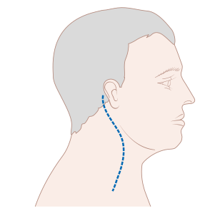 Dijagram koji prikazuje liniju ožiljka nakon disekcije limfnih čvorova na vratu CRUK 368.svg