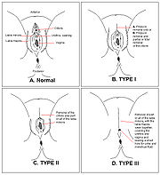 هذه الصورة تظهر أنواع الختان لدى الانثى مع تبيان الفرق مع الانثى الطبيعية