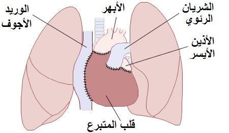 Heart transplant Arabic YM.jpg