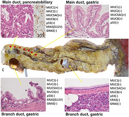 biliary papillomatosis intraductal papillary mucinous neoplasm)