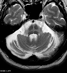 Een MRI-bevinding die vaak wordt gezien bij atrofie van meerdere systemen.  Dit gebeurt op de Pons.