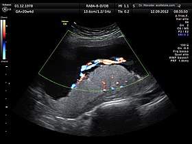 Human placenta umbilical cord Ultrasound by Dr. W. Moroder.jpg