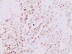 Immunohistochemistry for progesterone in invasive lobular carcinoma, staining 61-70 percent.jpg