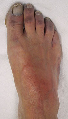 Hammer toe: MedlinePlus Medical Encyclopedia Image