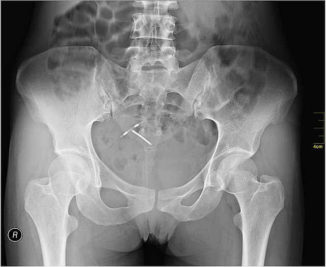 An IUD as seen on pelvic X ray