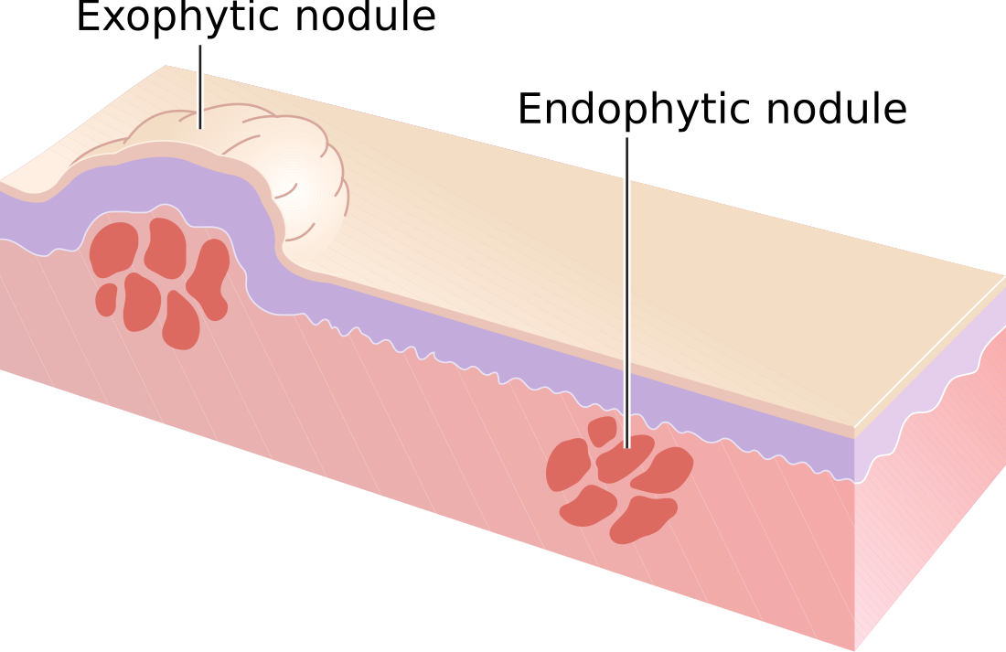 Nodule (medicine)