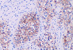 The germ cell markers OCT 3/4 and CD117 (positive immunohistochemistry pictured) are useful for diagnosis.